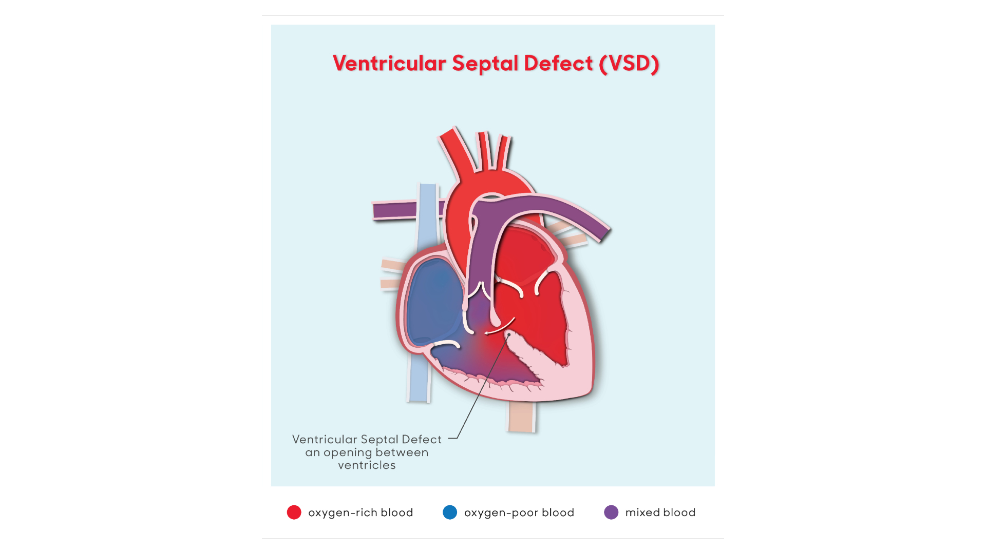 vsd