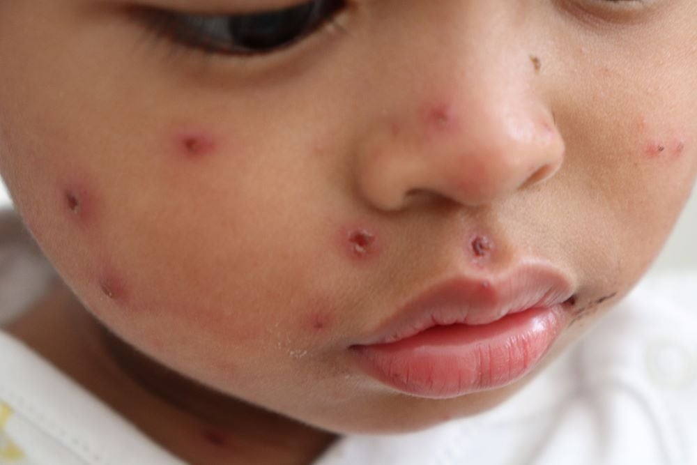 A toddler face with a measles rash on it