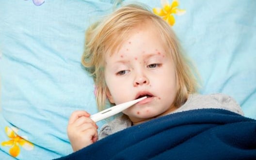 A toddler with a measles rash on his face lies on a pillow while holding a thermometer to his mouth.