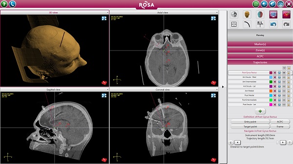Images from a brain scan for an epilepsy surgery candidate