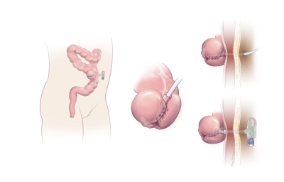 Illustration of an appendicostomy