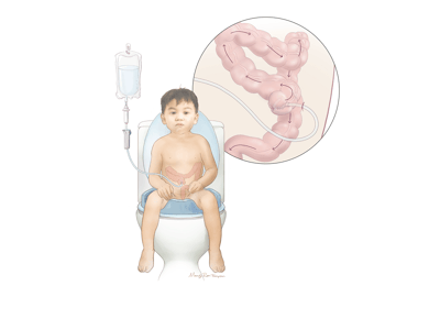 Illustration of a child on a toilet with an enema connection in his abdomen