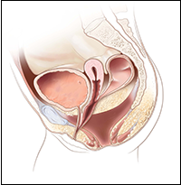 Cloaca with a very high rectum