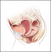 Cloaca with two hydrocolpos