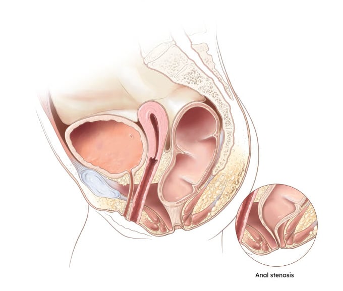 Rectal Altresia-Stenosis - Kay Update