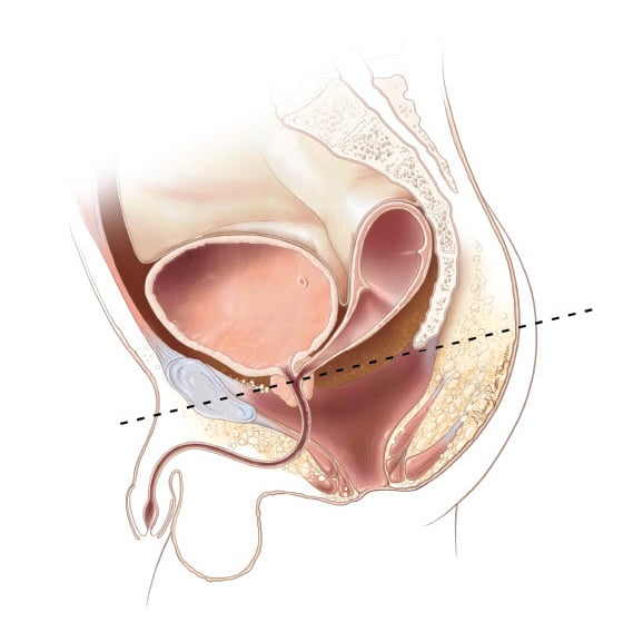 In this malformation the urethra and vagina are normal, and the distal rectum ends in the vestibule, just behind the vagina.  This malformation is ideally suited for a perineal preserving PSARP, which moves the rectum to within the center of the sphincter and does not cut the perineal body.