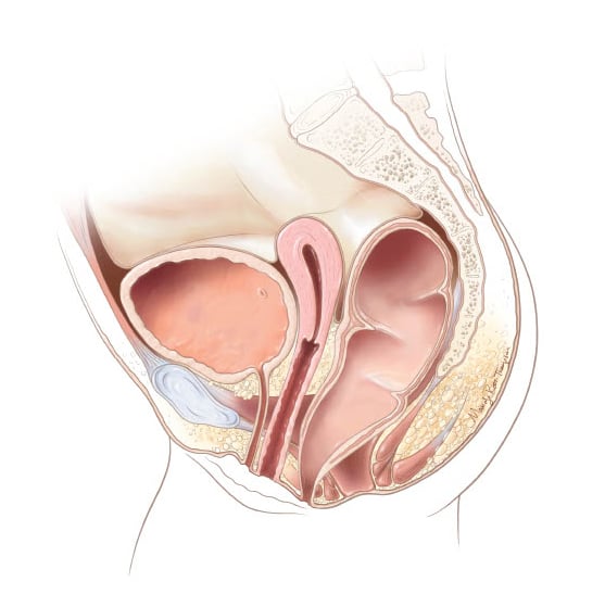 Rectoperineal fistula - Position 2