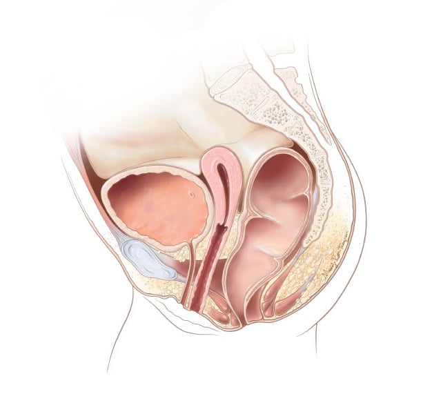 Rectoperineal fistula - Position 3