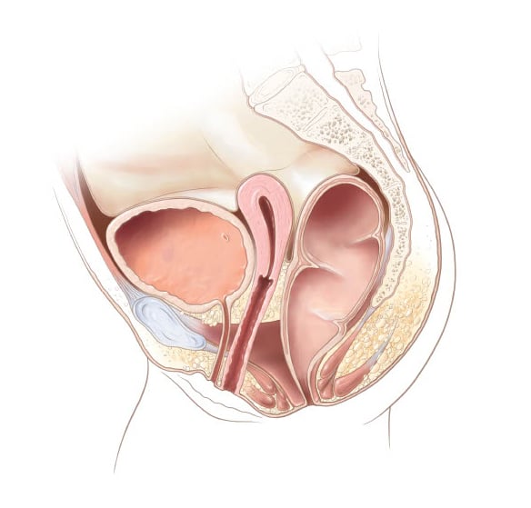 Rectoperineal fistula - Position 4