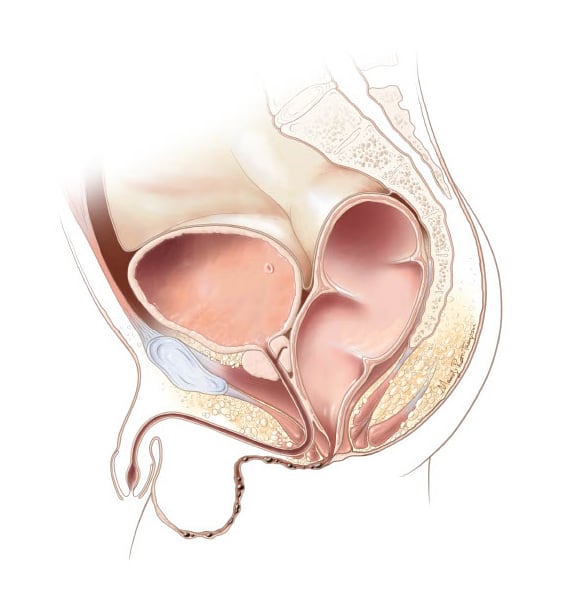 Rectoperineal fistula-male