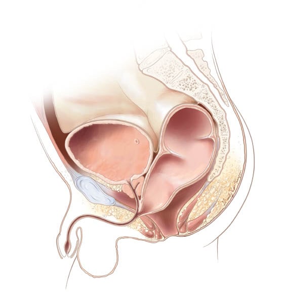 Rectourethral bulbar fistula