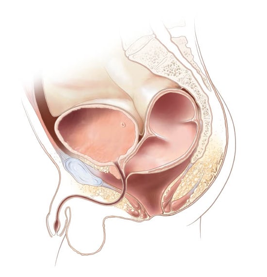 Rectourethral prostatic fistula