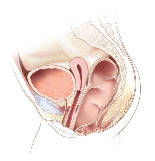 Rectovestibular Fistula