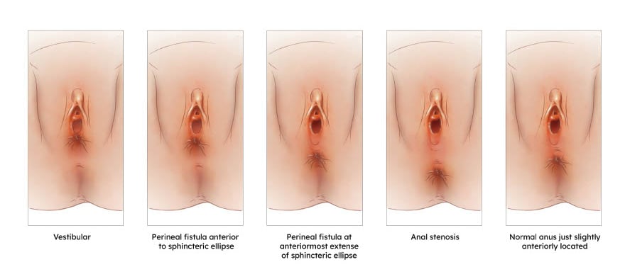 Variations of the distal rectum