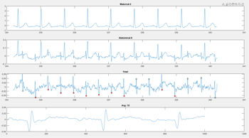 Fetal ECG on a 26-week gestation fetus: The maternal heart rates are shown in the top bar. The combination of mom’s and baby’s heart rates are shown in the middle bar. In the bottom bar, red dots indicate the fetal electrocardiogram separated out “beat to beat.”