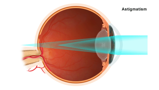 Astigmatism