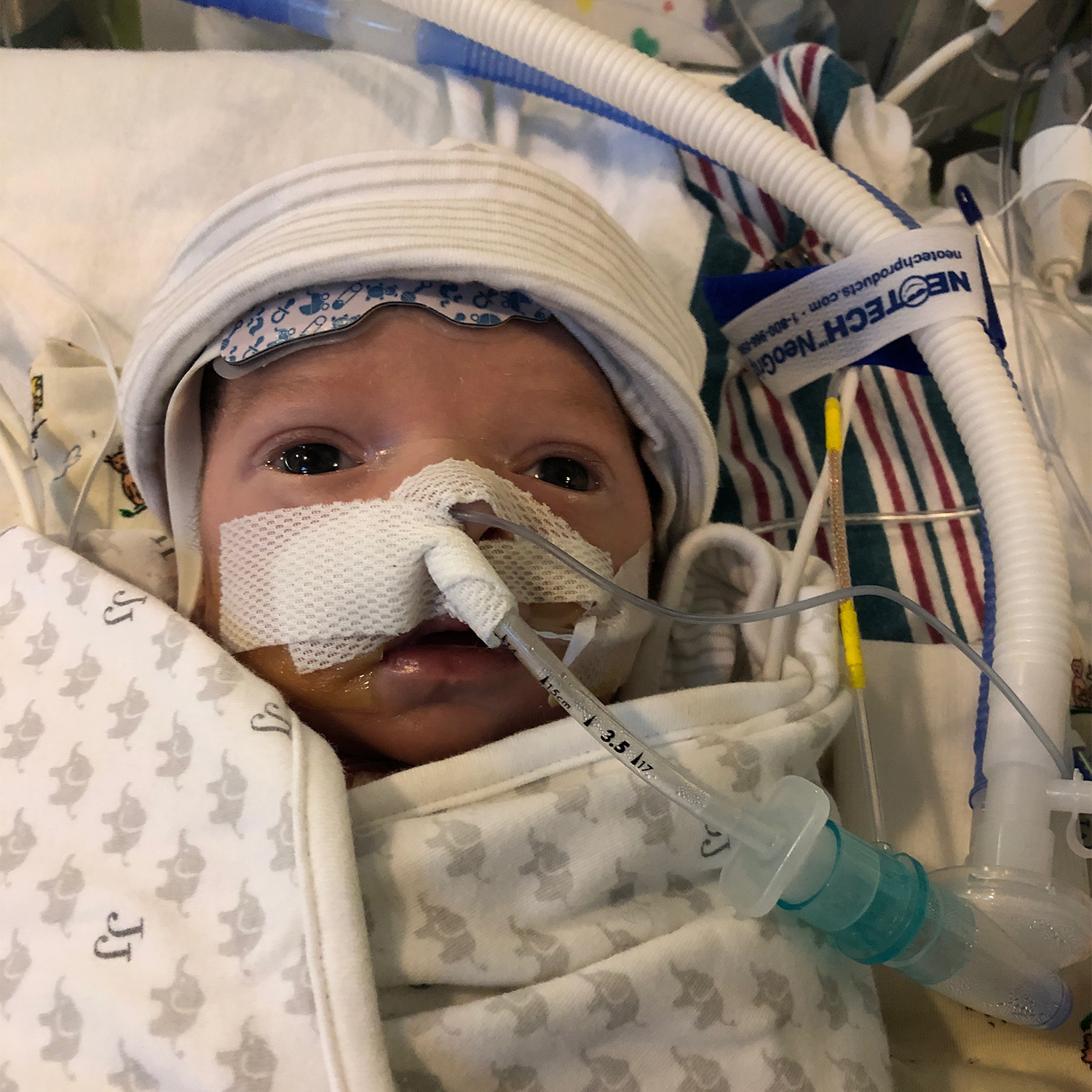 Baby John with a feeding tube at the hospital