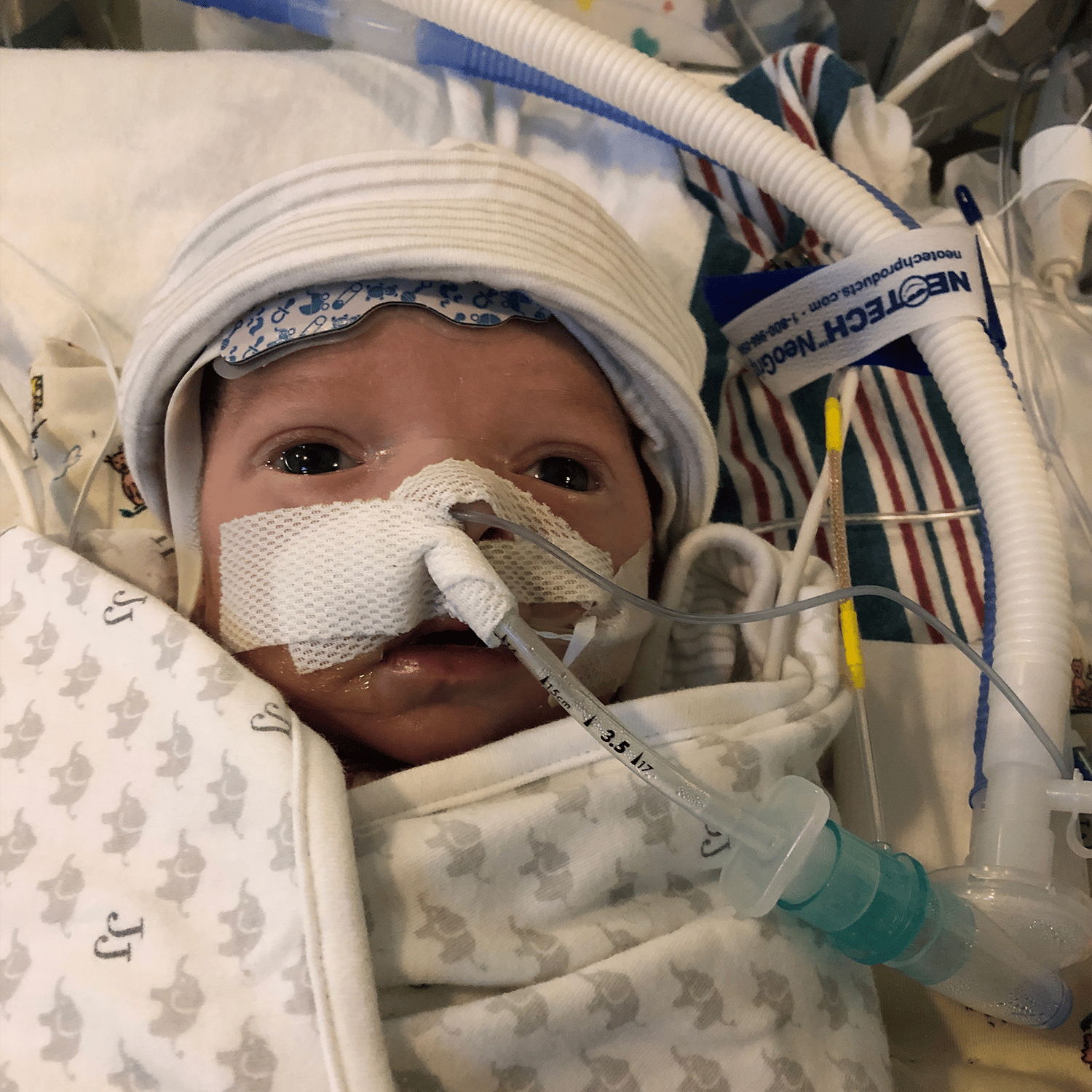 Baby John with a feeding tube at the hospital