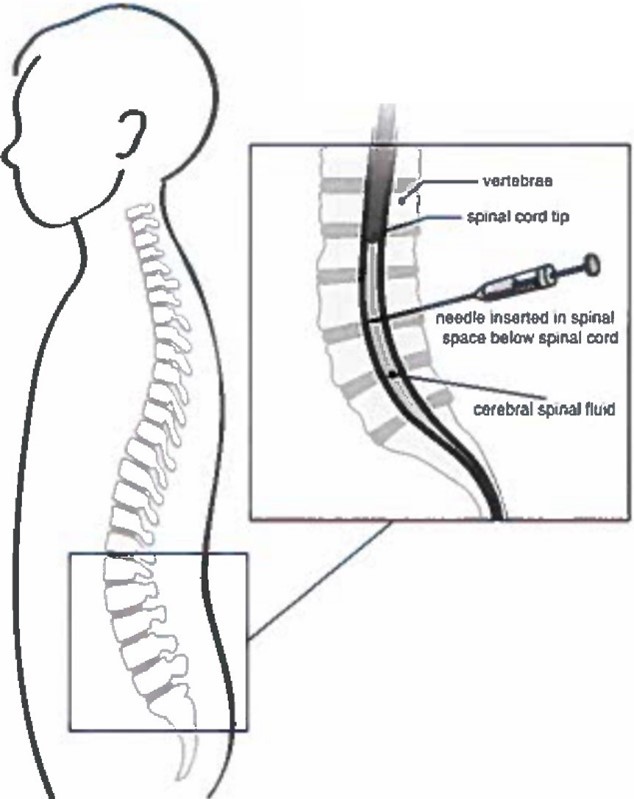 lumbar puncture diagram