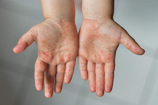 kid with enterovirus on hands