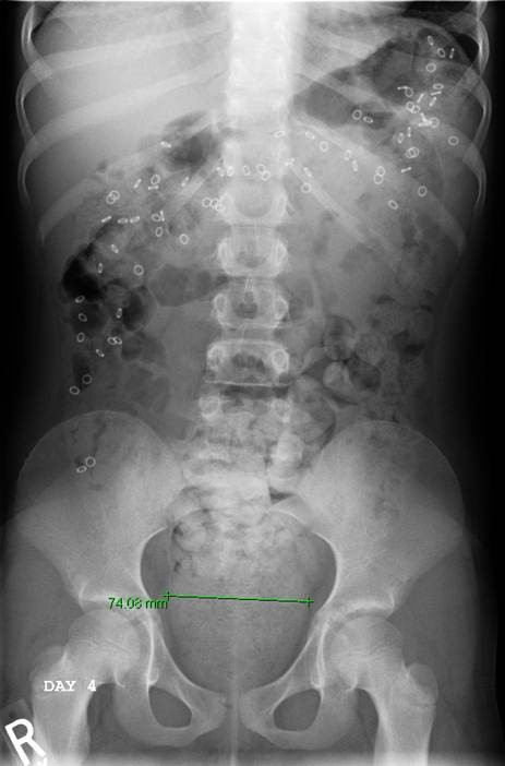 Sitz marker study demonstrating colonic dysmotility