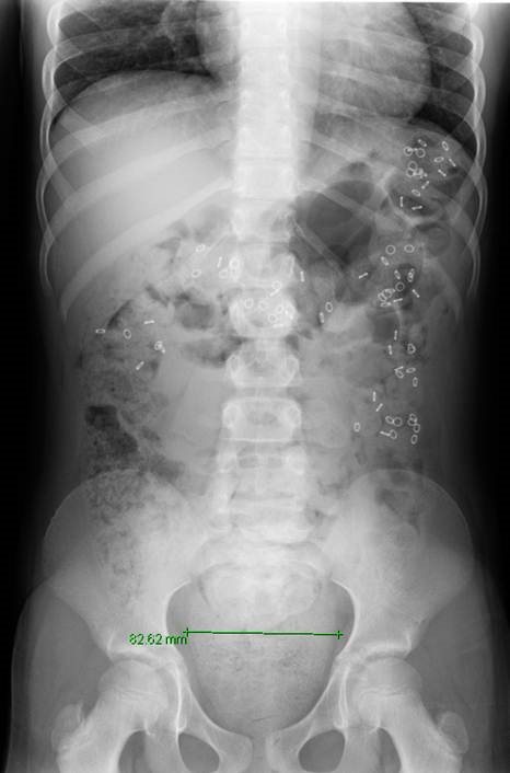 Sitz marker study demonstrating colonic dysmotility