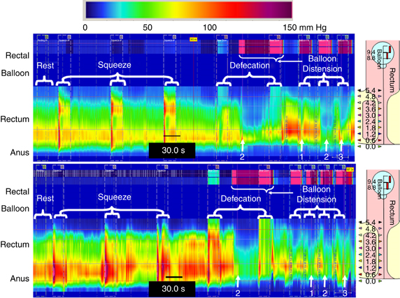 anorectal manometry tracing