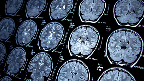 Multiple MRI images of a brain