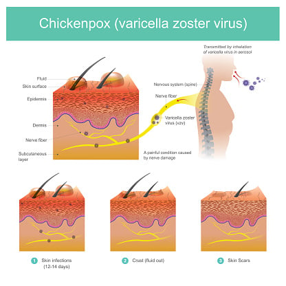 chickenpox