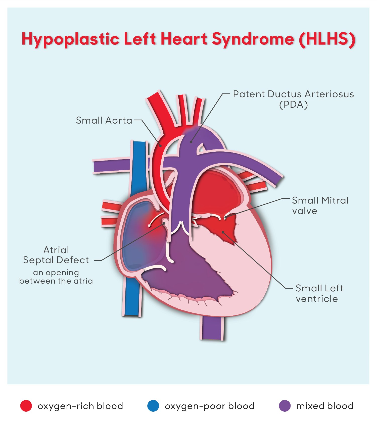 hlhs