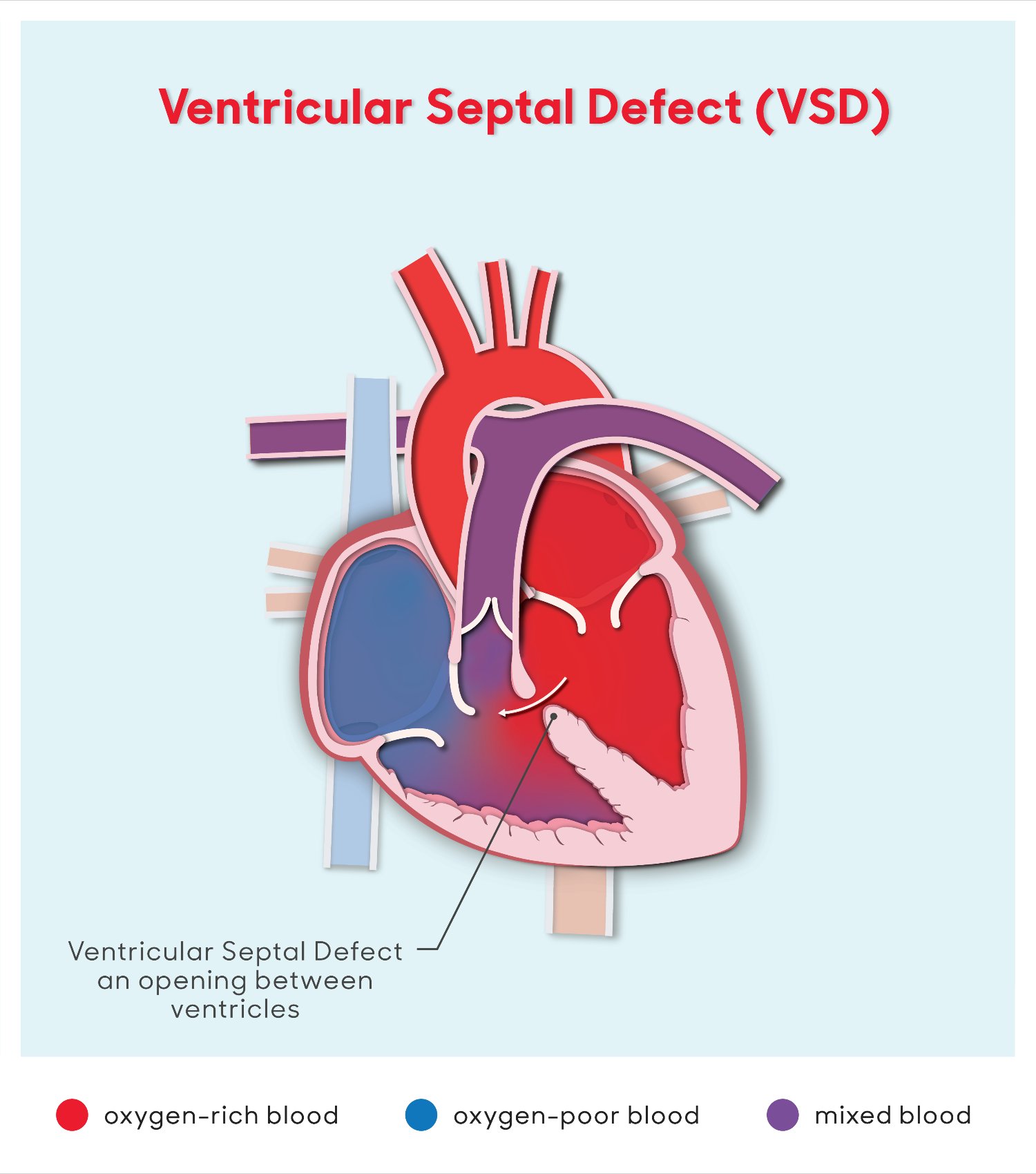 vsd