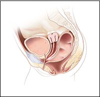 Cloaca with two hemivaginas