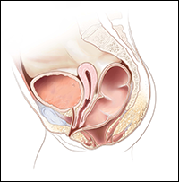 Cloaca with short common channel