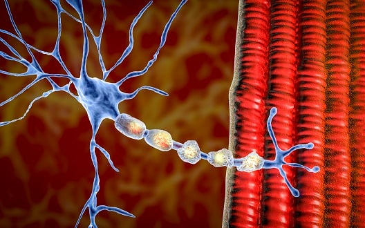 A 3D illustration of the damage of the neuron myelin sheath seen in demyelinating diseases.