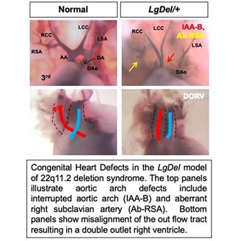 Heart Defect