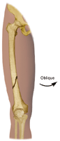 Illustration of oblique fracture