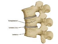 Illustration of a compression fracture