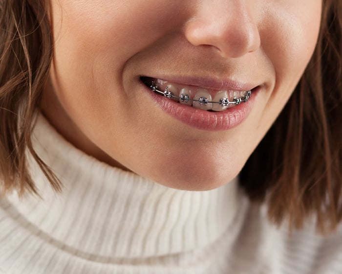 Smile with braces