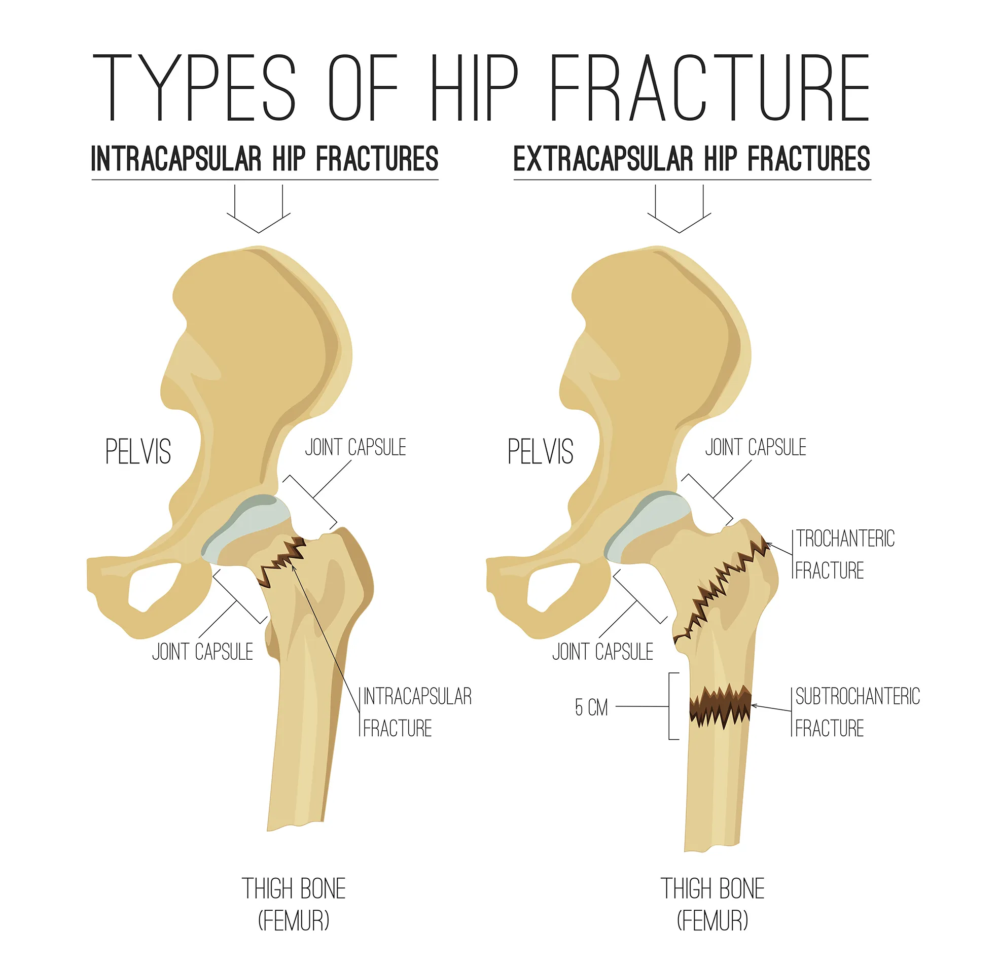 Diagram showing two types of hip fractures: intracapsular (inside joint capsule near femoral neck) and extracapsular (outside joint capsule, including trochanteric and subtrochanteric fractures). Labels indicate pelvis, joint capsule, and thigh bone (femur).