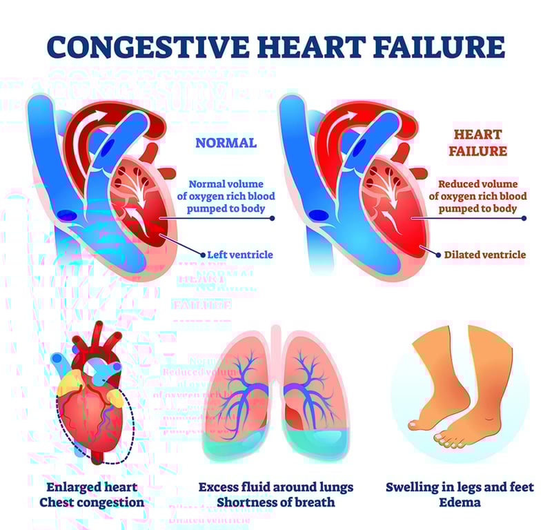 congestive heart failure graphic