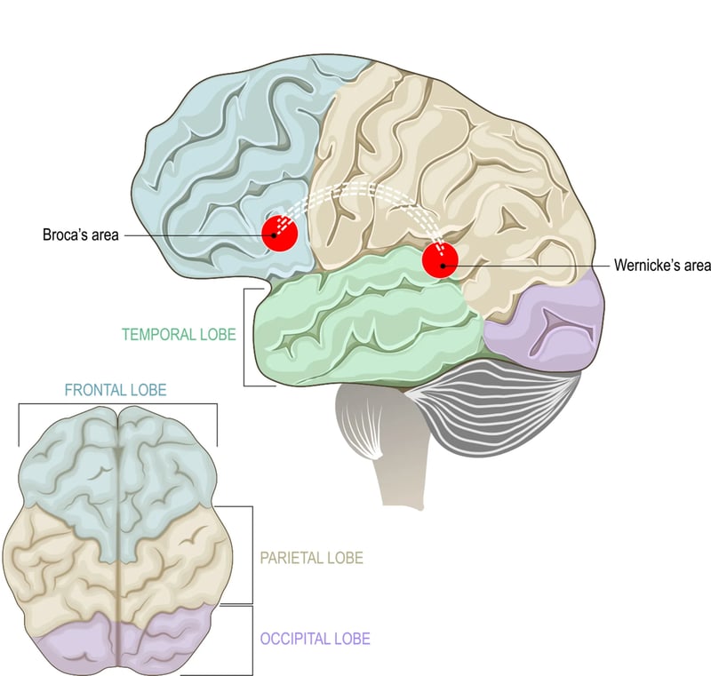 A chart displaying the impacts of aphasia in the frontal and temporal lobe of the brain.