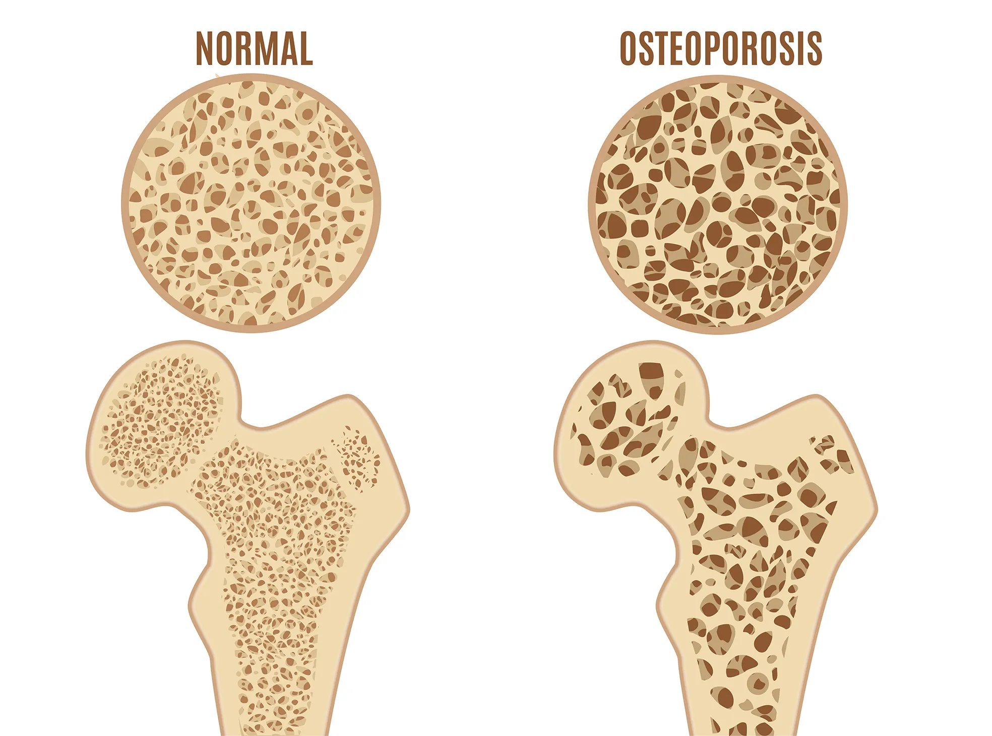 A comparable graphic of a normal bone and bone with osteoporosis. 
