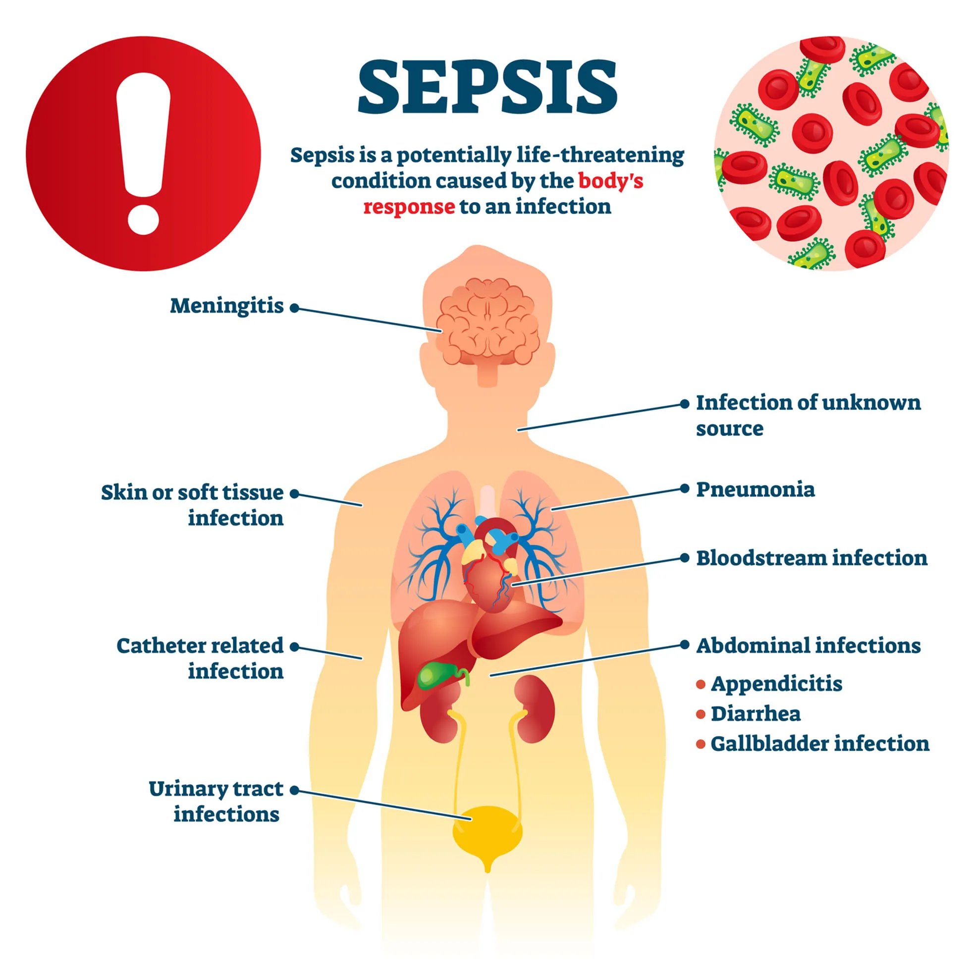 Graphic of common sources of sepsis