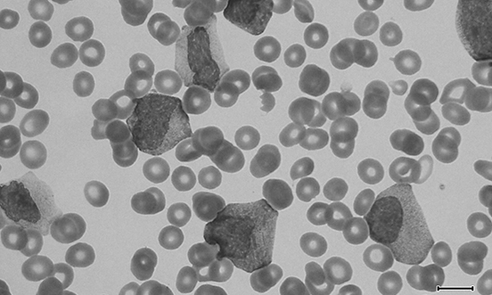 Bolstering regional Australians fight against blood cancer
