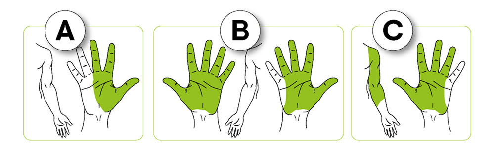 Prevalencia y sintomatología del síndrome del túnel carpiano