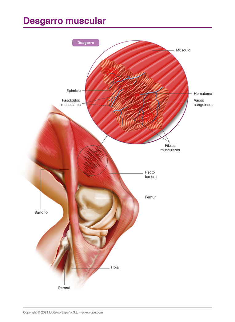 desgarro muscular