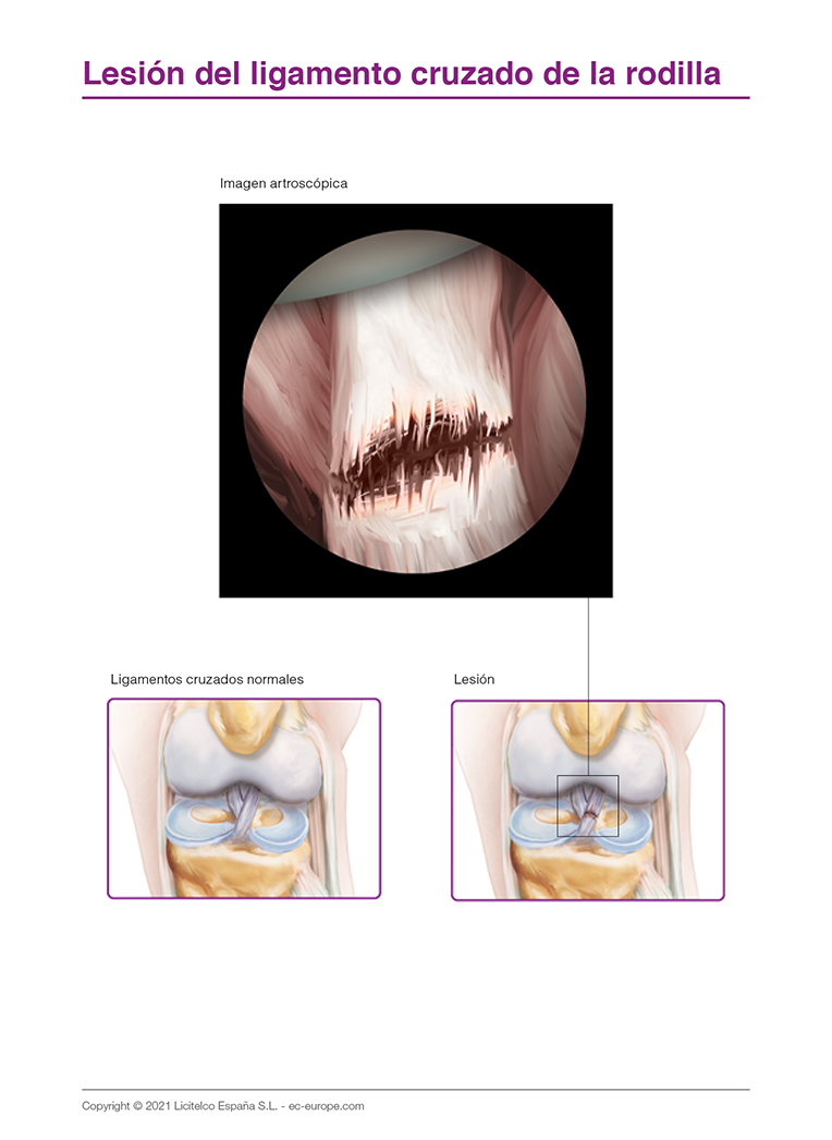 lesión de ligamento cruzado de la rodilla