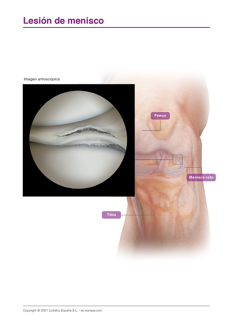 lesión de menisco