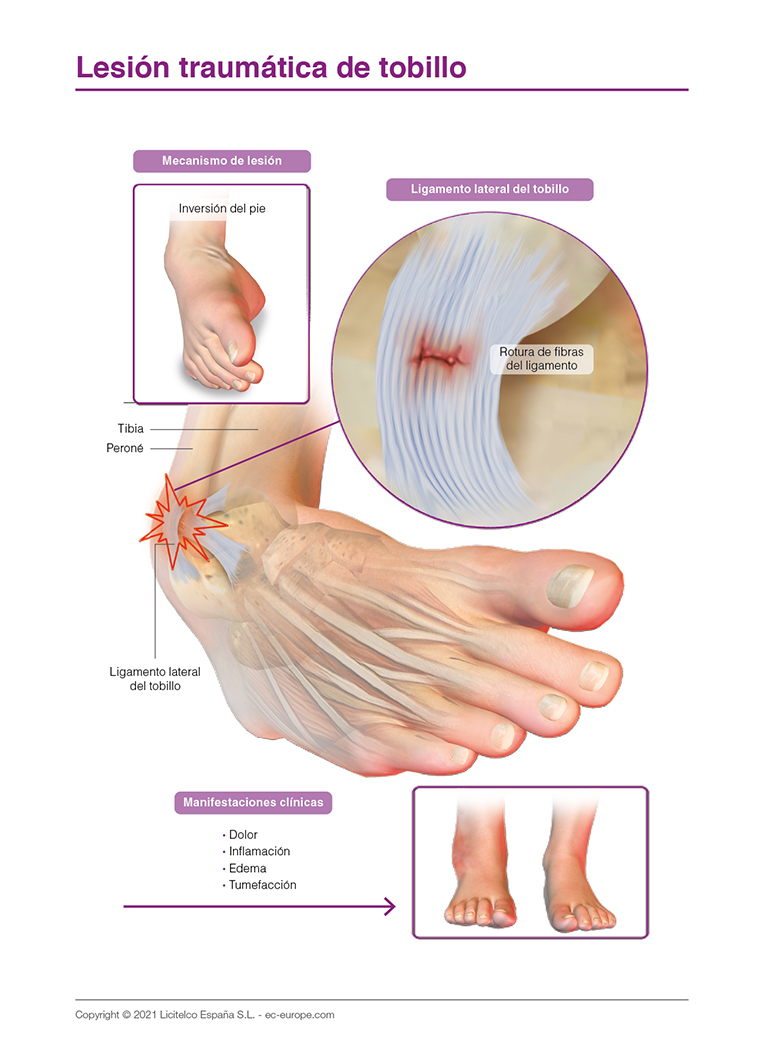 lesión traumática de tobillo
