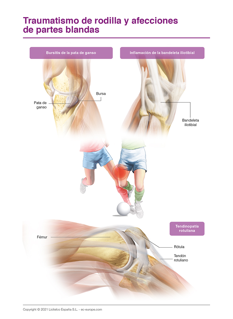traumatismo de rodilla y afecciones de partes blandas